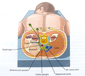 تزریق Celiac Plexus
