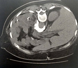 CT Scan محل شبکه سلیاک