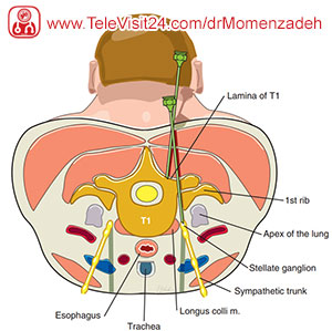drMomenzadeh, پروفسور دکتر سیروس مومن زاده,  دکتر سیروس مومن زاده ,سیروس مومن زاده, پروفسور سیروس مومن زاده, درد شناسی, فوق تخصص, درمان درد, درد, لیزر درمانی, لیزرتراپی, ازن تراپی, اوزون درمانی, درد کمر, کمردرد, درد پا, درد گردن, گردن درد, درد دست, زانو درد, درد زانو,   مفاصل فست گردنی, ستون فقرات, آرتریت, پشت سر, ضعف سیستم ایمنی, گاید سونوگرافی,  درد حنجره, درد حنجره, درد دهان, عصب گلوسوفارنژیال, بلاک گانگلیون ستلایت, Stellate ganglion