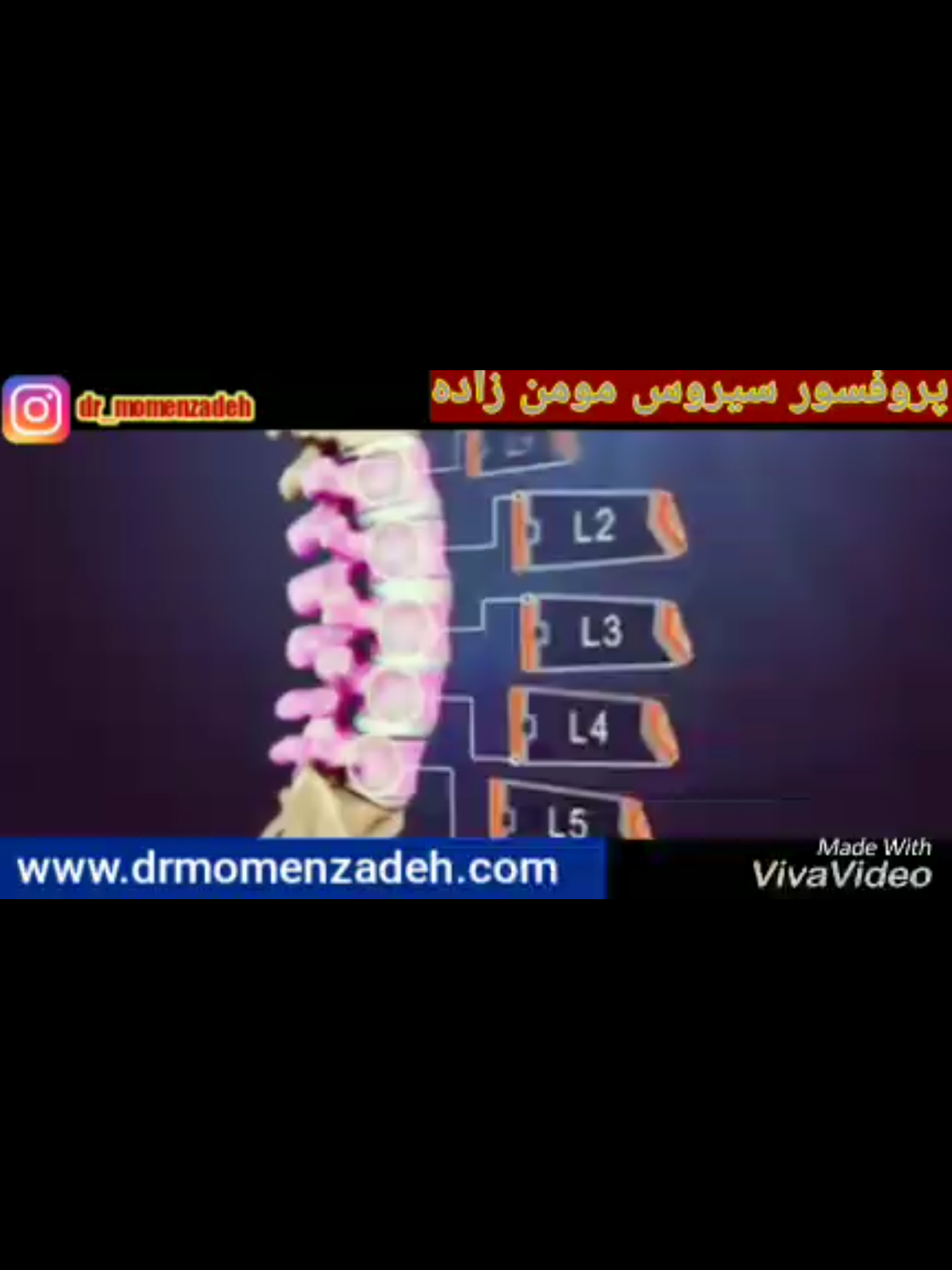 فشار شدید دیسک کمر به کانال نخاعی