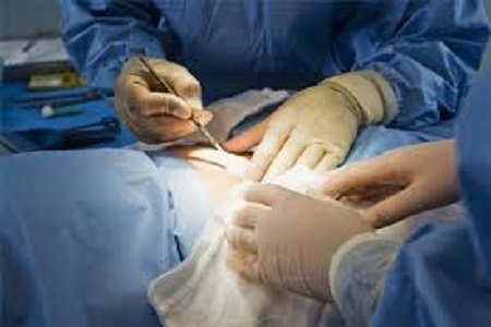 سندرم شکست جراحی کمر (FBSS)چیست؟ 
