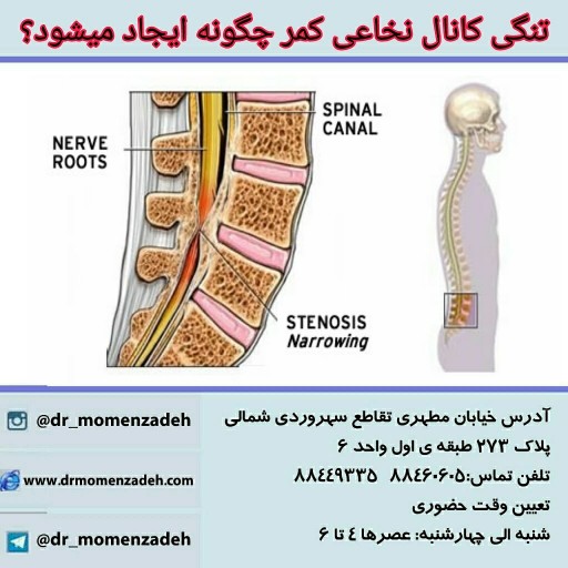  تنگی کانال نخاعی در ستون مهره کمری چگونه ایجاد میشود؟