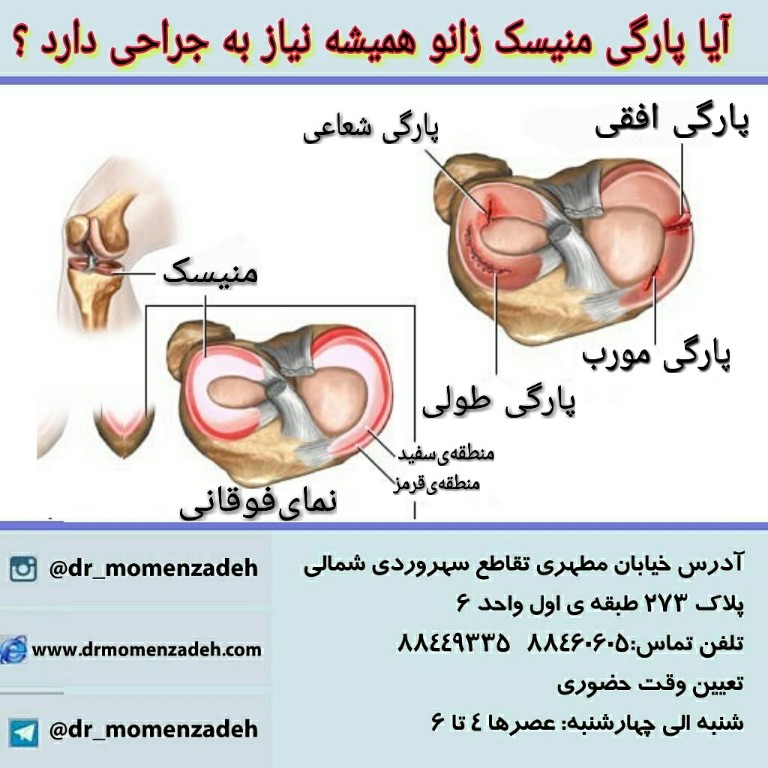 آیا پارگی منیسک زانو همیشه نیاز به جراحی دارد ؟