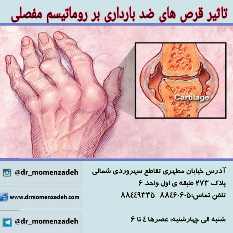 تاثیر قرص های ضد بارداری بر روماتیسم مفصلی