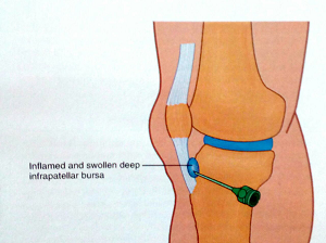 درمان درد زانو با تزریق داخل تندون عضله چهارسر