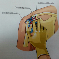 درمان درد شانه با تزریق داخل بورس سابکوراکوئید (subcoracoid)