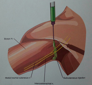 درمان درد سطح داخلی آرنج با بلاک اعصاب مدیال کتانوس (medial cutaneos) و اینترکوستوبراکیال (intercost