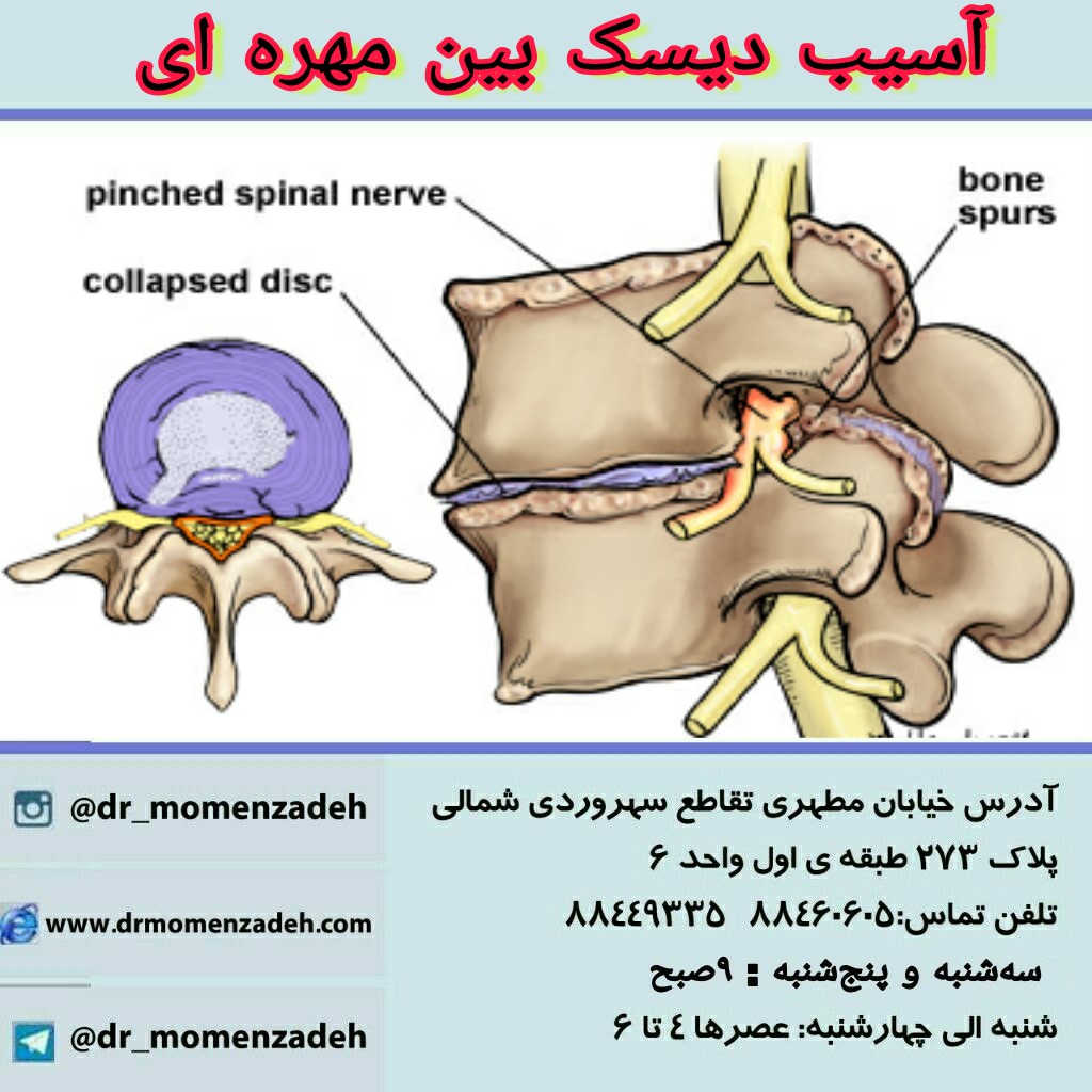 آسیب دیسک بین مهره ای :