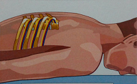 درمان درد قفسه سینه با بلاک عصب بین دنده ای
