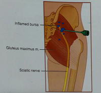 داخل بورس گلوتئال (Gluteal)  درمان درد پشت باسن با استفاده از تزریق بورس ایسکیال (Ischial)