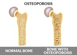 درمان درد پوکی استخوان و علائم آن 
