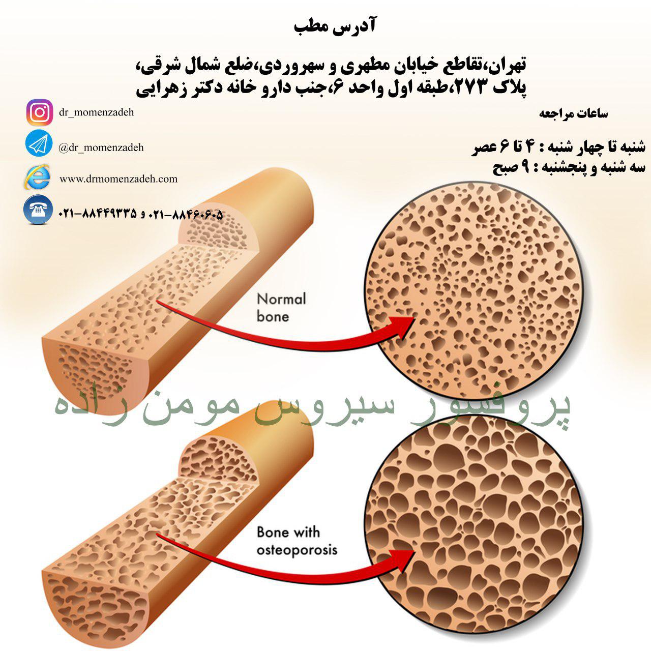 درمان درد پوکی استخوان و علائم آن