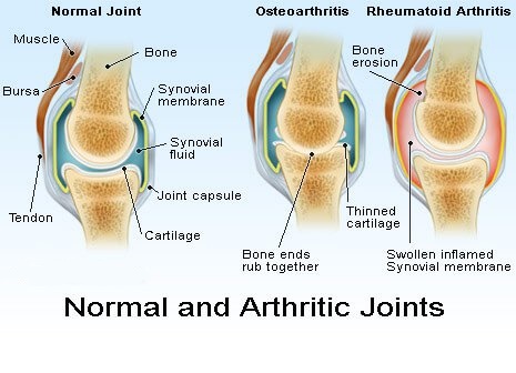انواع آرتریت ها و درمان درد آنها 