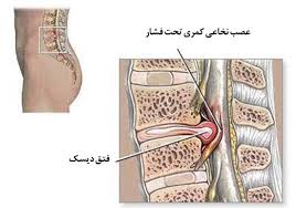 انواع درمان دیسک کمر