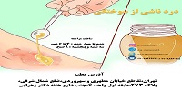 درد ناشی از سوختگی