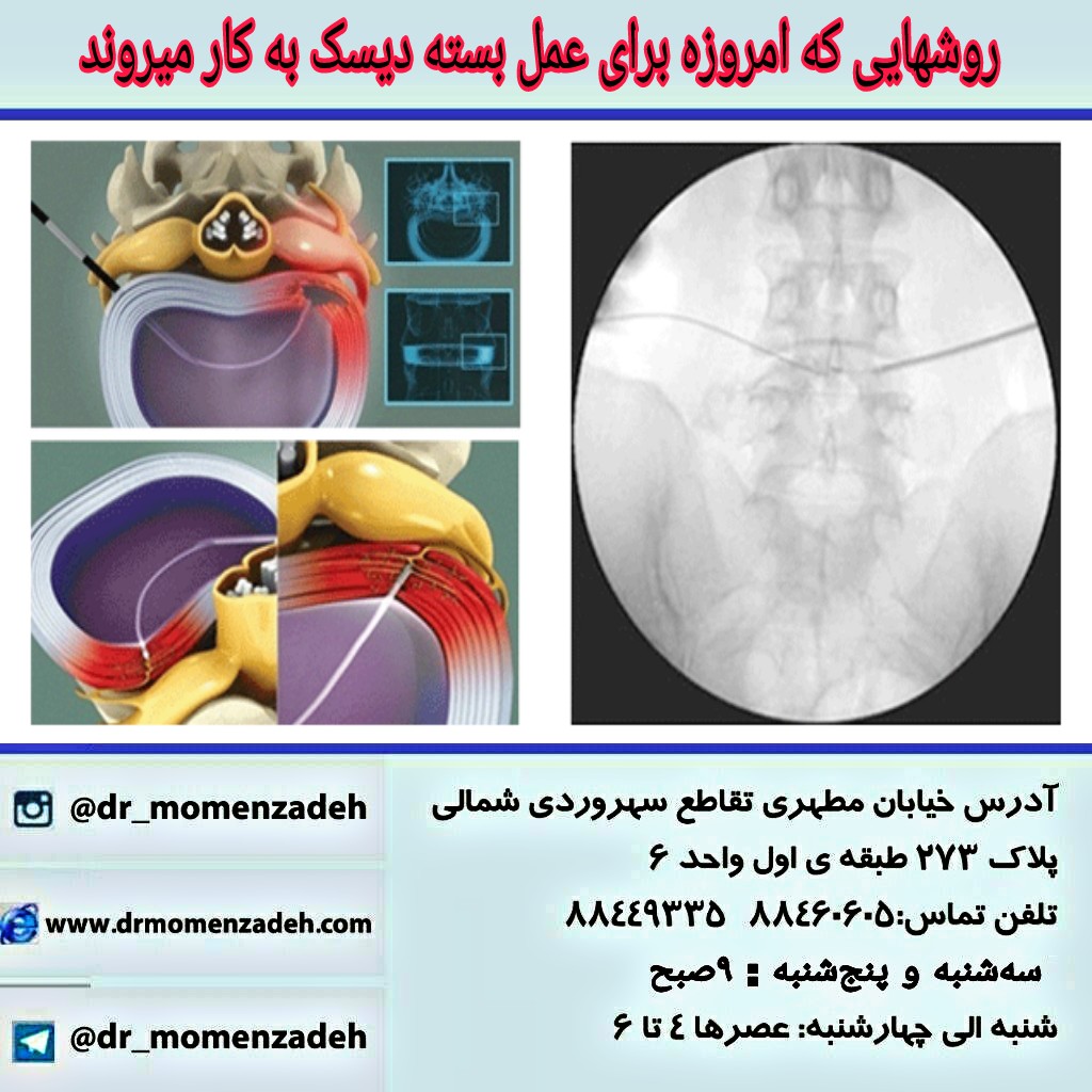 روشهایی که امروزه برای عمل بسته دیسک کمر ، گردن ، تنگی کانال نخاعی به کار میروند: