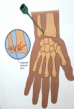 درمان درد مچ دست با تزریق داخل مفصل رادیواولنار تحتانی