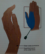 درمان درد مچ و کف دست با بلاک عصب رادیال در سطح مچ