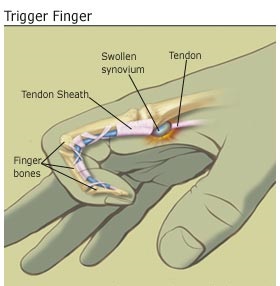 درد انگشت ماشه ای یا تریگر فینگر trigger finger