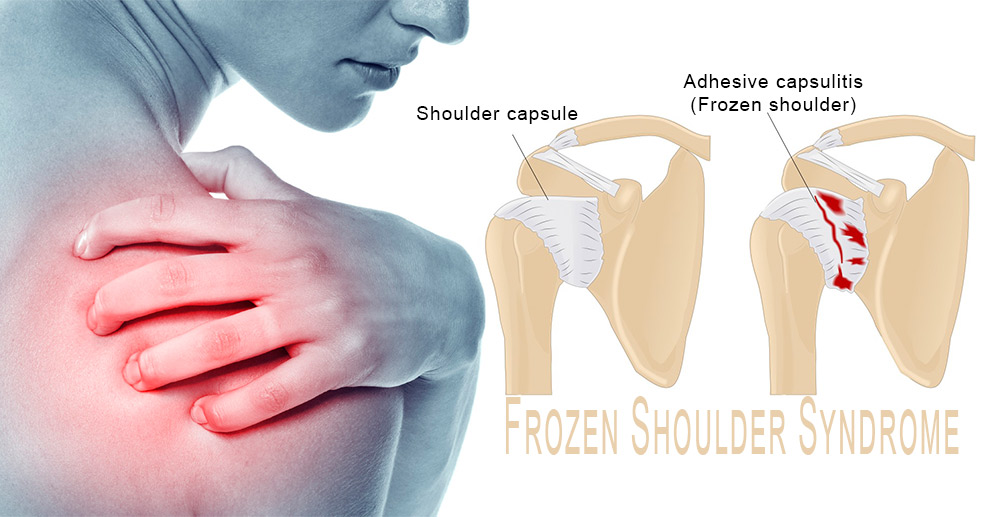 درمان درد سندروم شانه یخ زده (Frozen shoulder syndrome) با تزریق