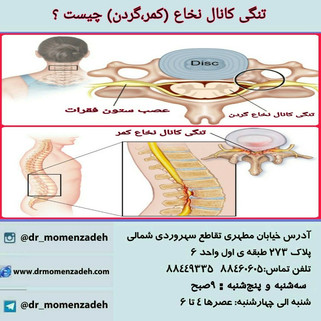 تنگی کانال نخاع چیست ؟