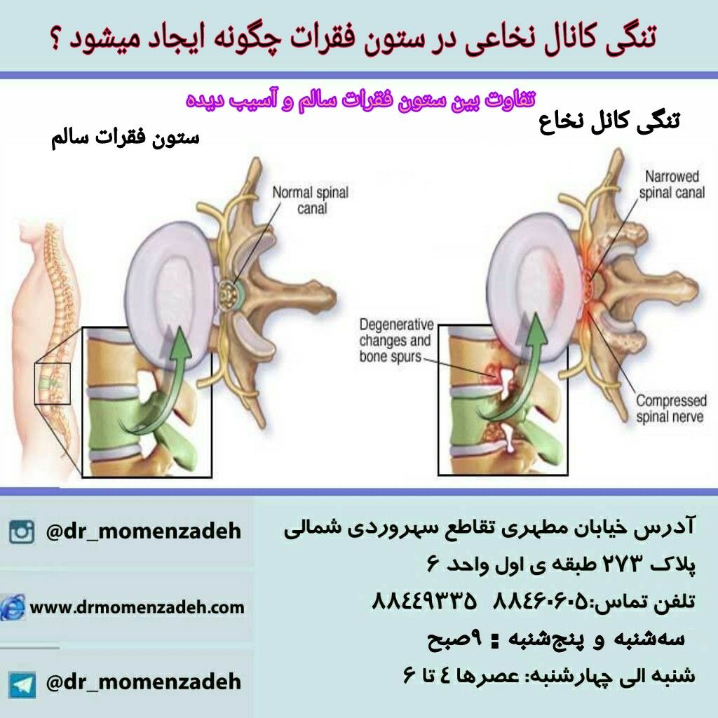 تنگی کانال نخاعی در ستون مهره کمری چگونه ایجاد میشود