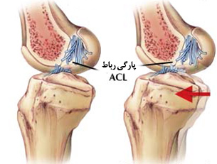 درمان درد پارگی رباط صلیبی