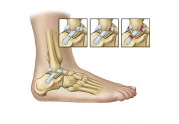 درمان درد مچ پا با تزریق داخل لیگامان تالوفیبولار قدامی