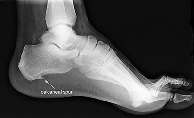 درمان درد پاشنه پا ناشی از کالکانئال اسپورس (Calcaneal Spurs) با تزریق