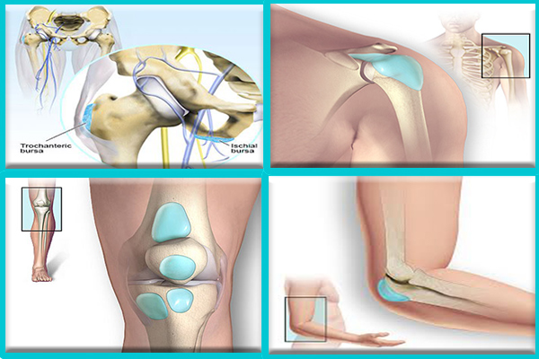 بررسی درد انواع بورسیتها یا التهاب کیسه بین رباط ها، عضلات و استخوان ها