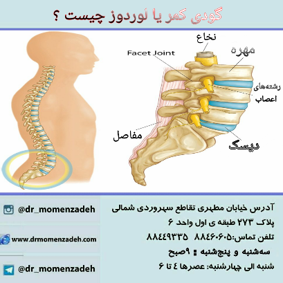  گودی کمر یا لوردوز چیست ؟