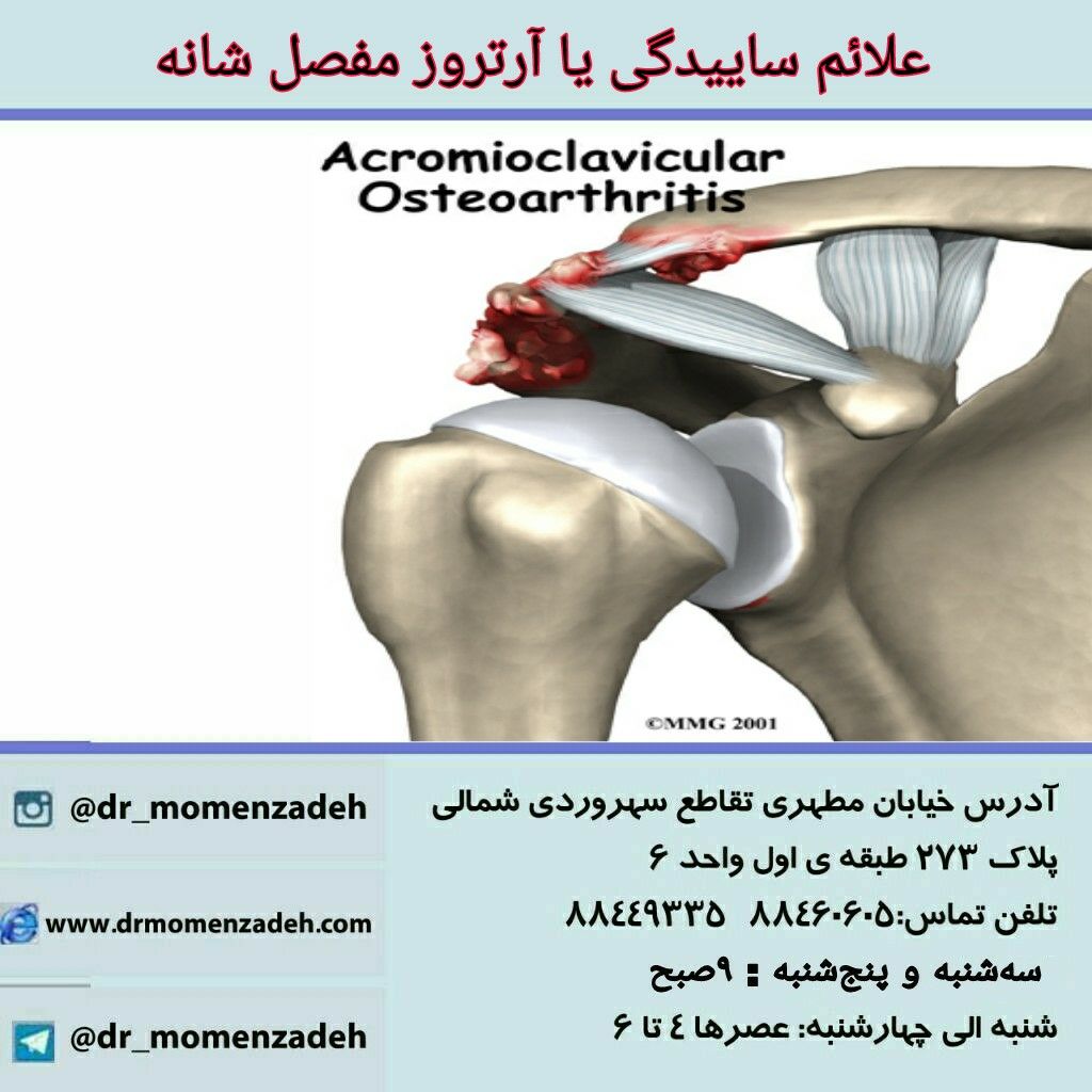  علائم ساییدگی یا آرتروز مفصل شانه 