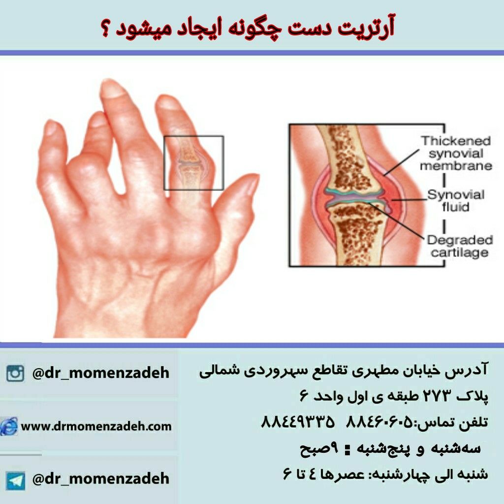  آرتریت دست چگونه ایجاد میشود ؟
