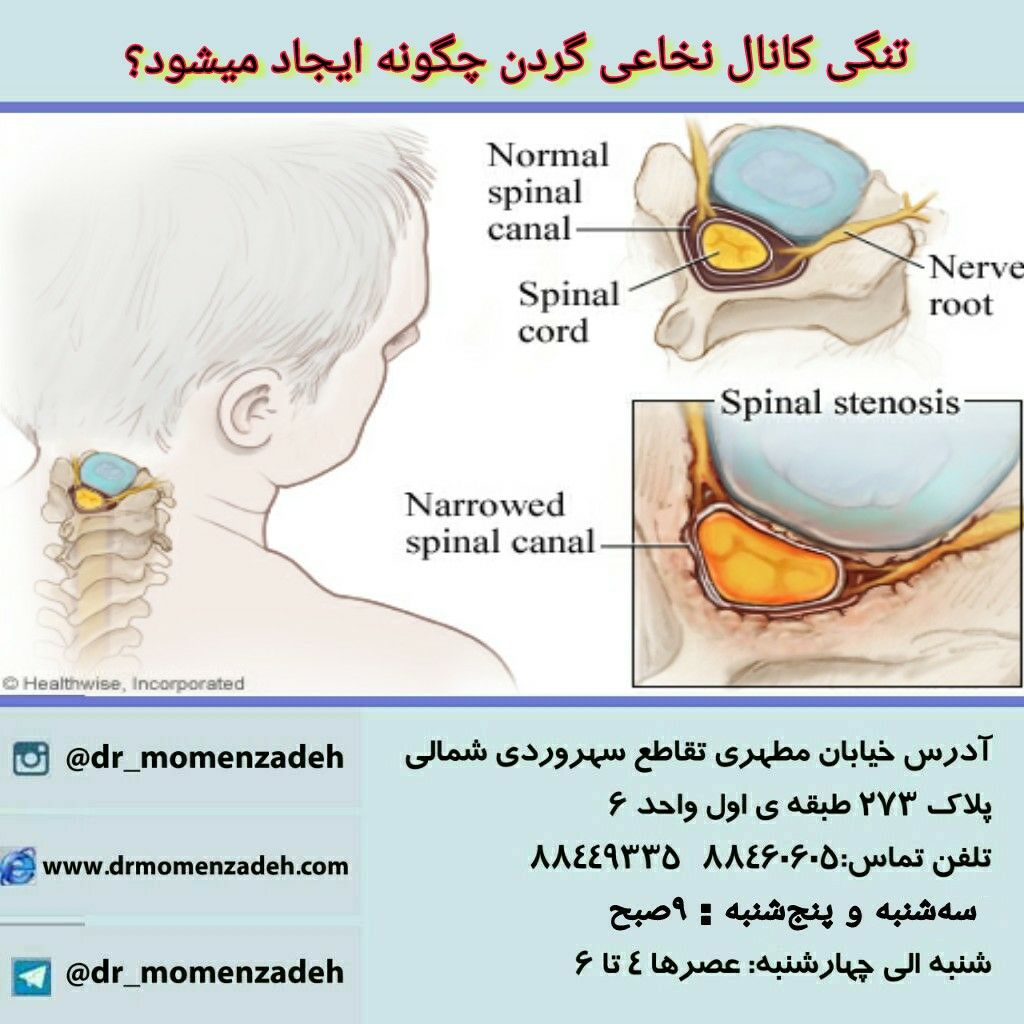 تنگی کانال نخاعی گردن چگونه ایجاد میشود؟ 