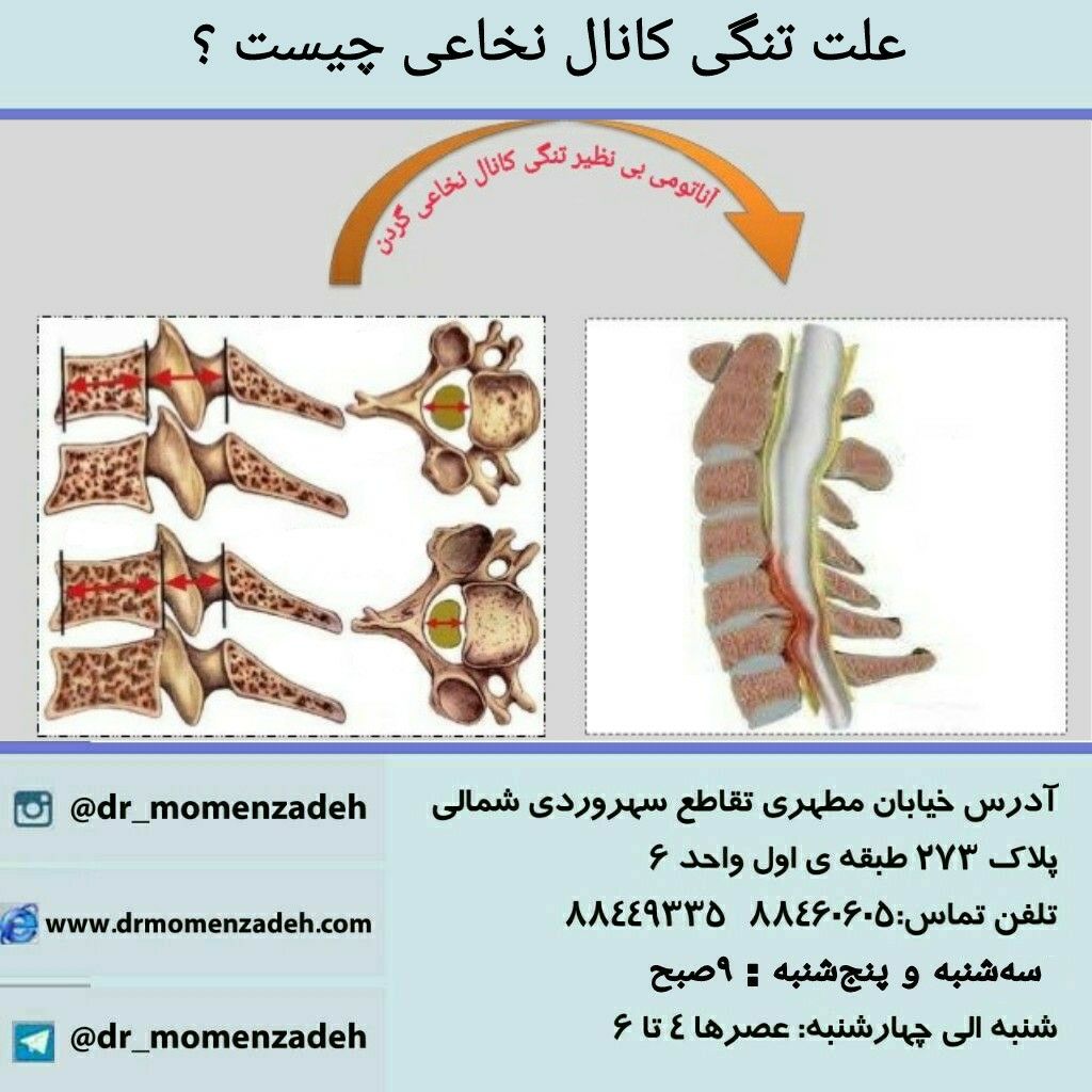  علت تنگی کانال نخاعی چیست ؟