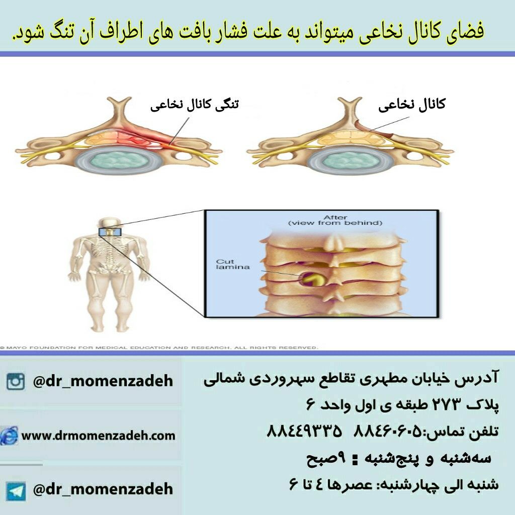 علت ایجاد تنگی کانال نخاعی گردن