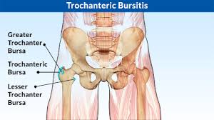 درد لگن ناشی از بورسیت تروکانتر