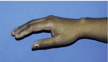 درمان درد مچ دست ناشی از کیست گانگلیونی با تزریق