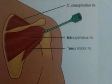درمان درد شانه با تزریق به تندون اینفرااسپایناتوس (infrapinatus)