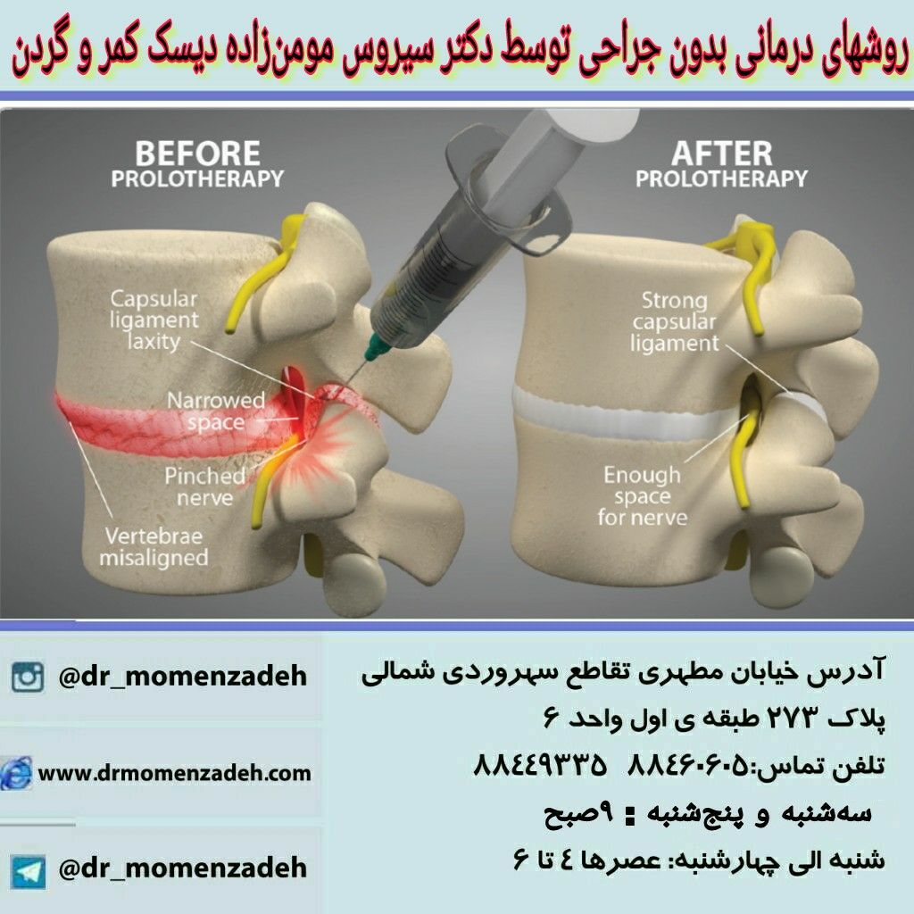 روشهای درمان بدون جراحی دکتر سیروس مومن‌زاده