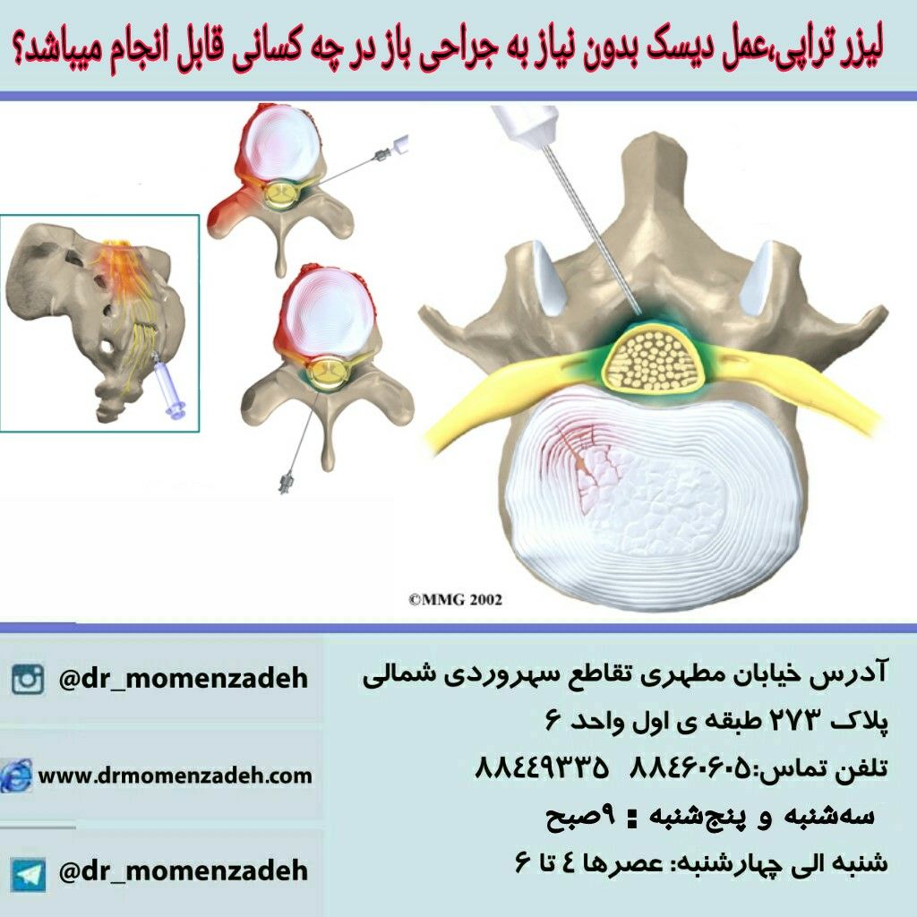 این روش(درمان لیزرتراپی بدون نیاز به جراحی باز ) در چه کسانی قابل انجام میباشد؟