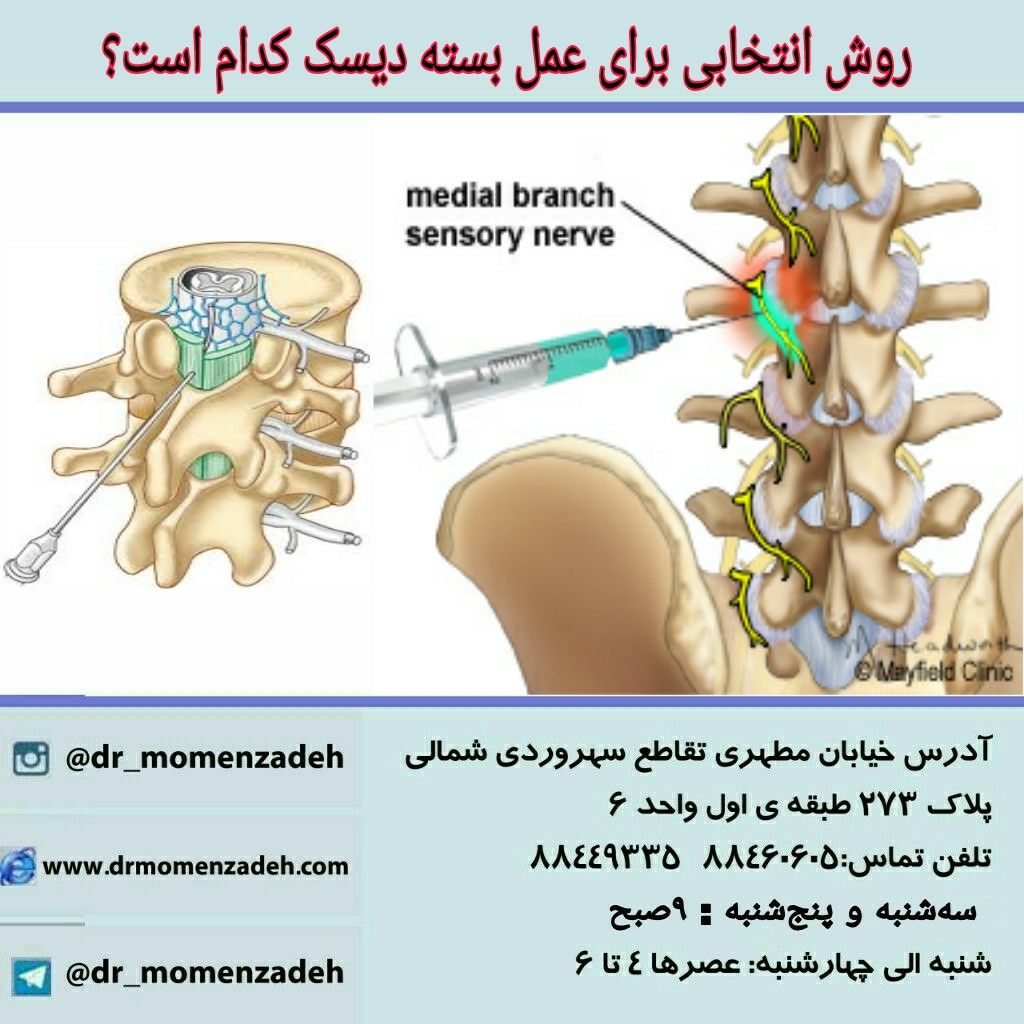 روش انتخابی برای عمل بسته دیسک کدام است؟