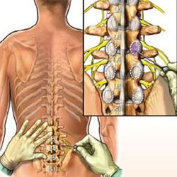 درمان درد پا و لگن با بلاک اعصاب سمپاتیک کمری (Lumbar Sympathetic)