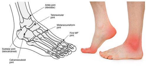 درمان درد روی پا با تزریق داخل مفصل تالونویکولار (Talonavicular)