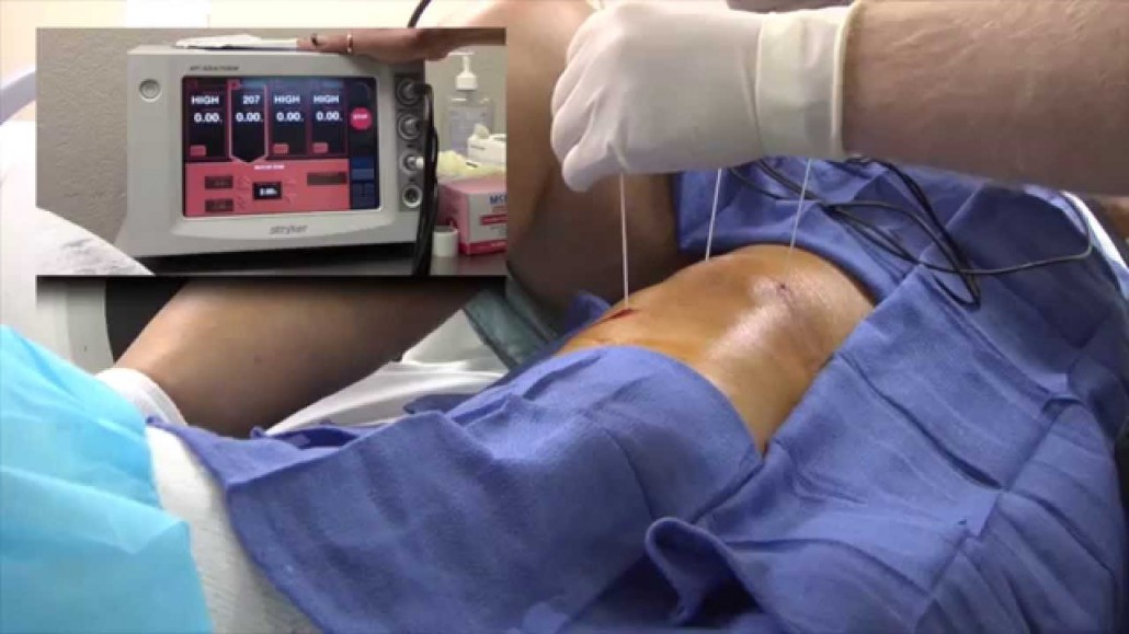 درمان درد ساق پا با بلاک عصب سافنوس (saphenous) در زانو