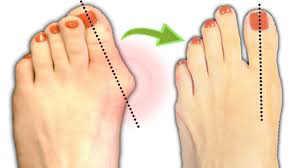 درمان هالوکس والگوس (Hallux Valgus) با تزریق