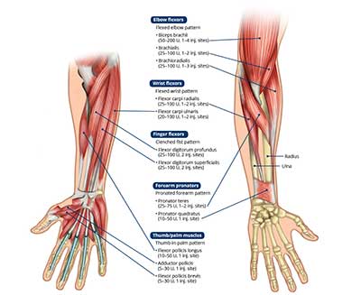 درمان درد ساعد و بازو ناشی از سندروم براکیورادیالیس (Brachioradialis) با تزریق