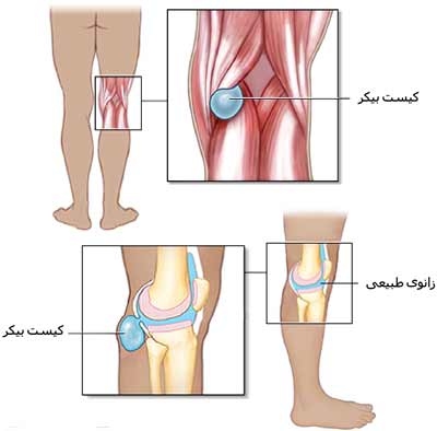 برجستگی پشت زانو یا کیست بیکر یا کیست پوپلیته چیست