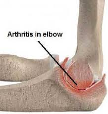 آرتریت آرنج و روش های مختلف درمان
