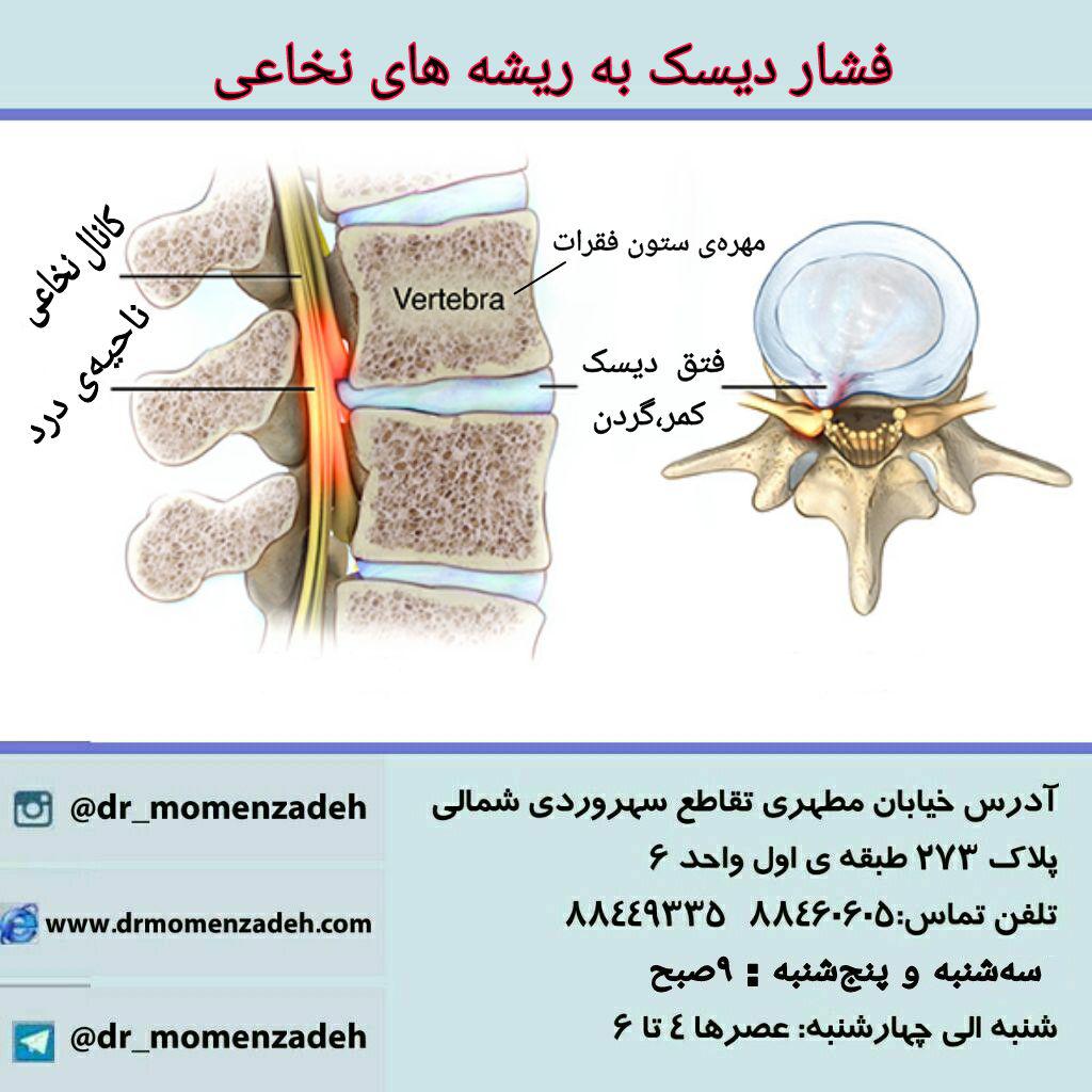 فشار دیسک به ریشه های نخاعی